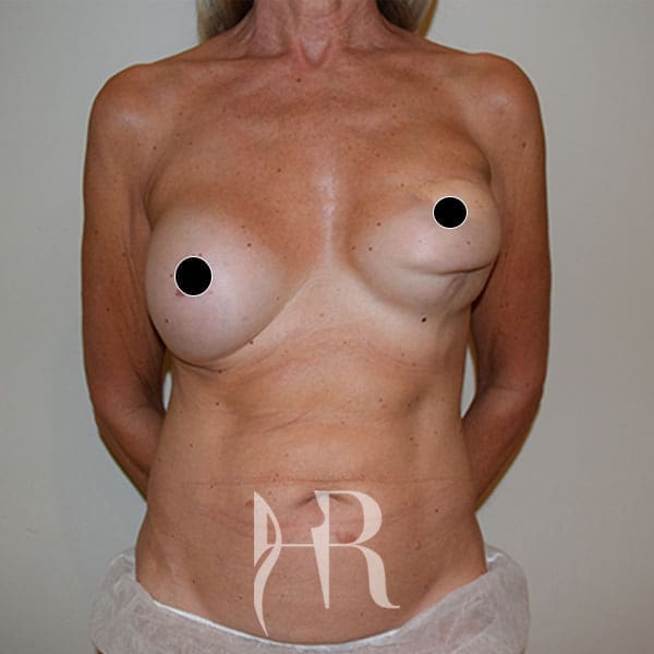 HR Plastic Surgery - Breast Reconstruction patient before 1